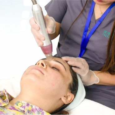 Rf Microneedling