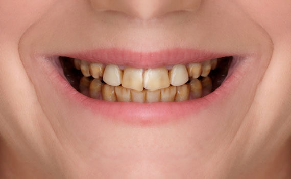smile 4 1