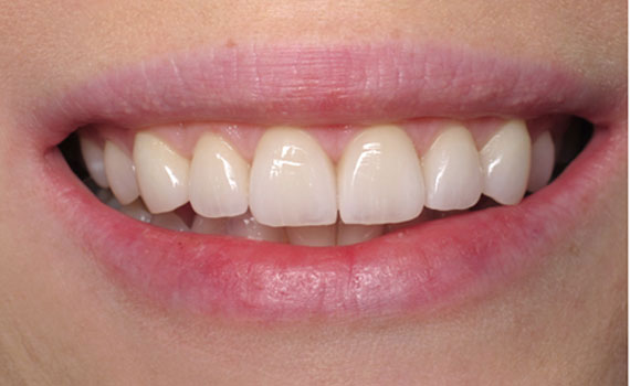 smile 6 2